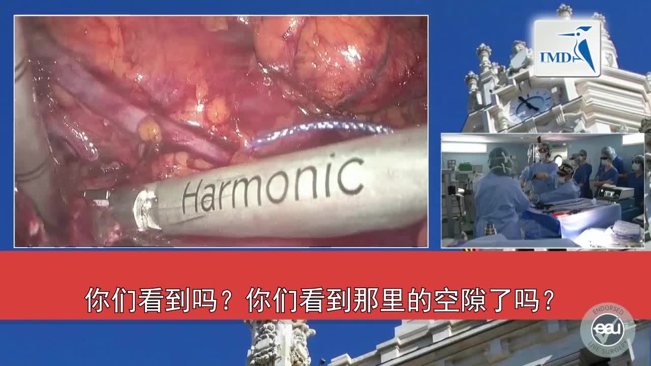 3D高清SPIES系统辅助腹腔镜部分肾切除术（3）