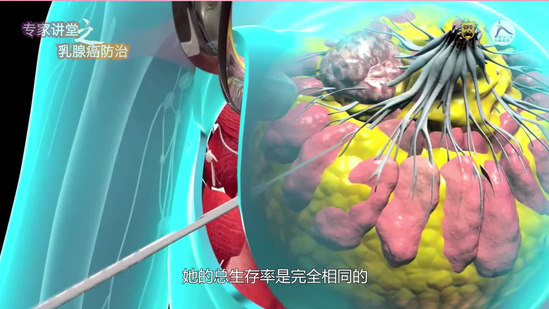 21 谢晖-乳腺保乳手术适合哪些患者？