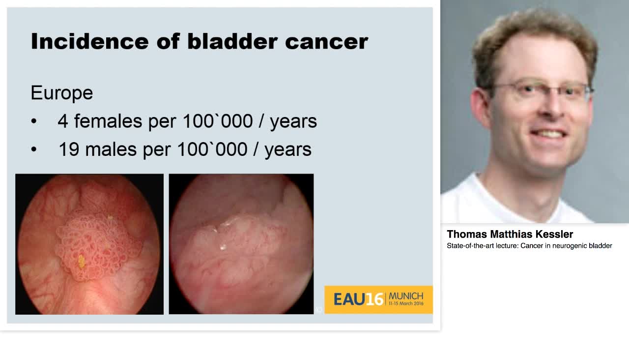 Cancer in neurogenic bladder