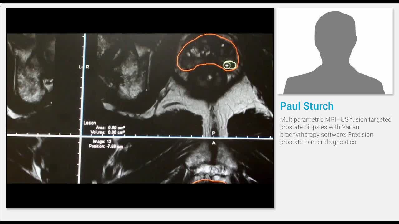 Multiparametric MRI-US fusion targeted prostate biopsies ..-