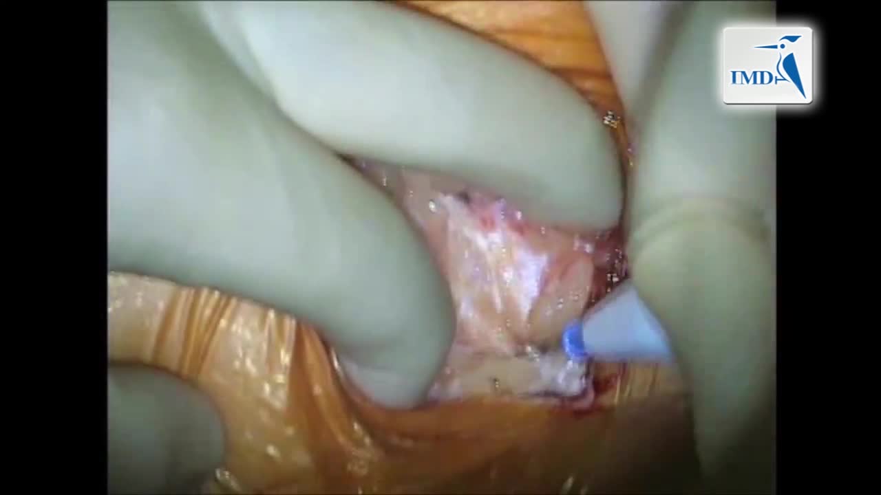 经导管主动脉瓣置换术的要点（2）