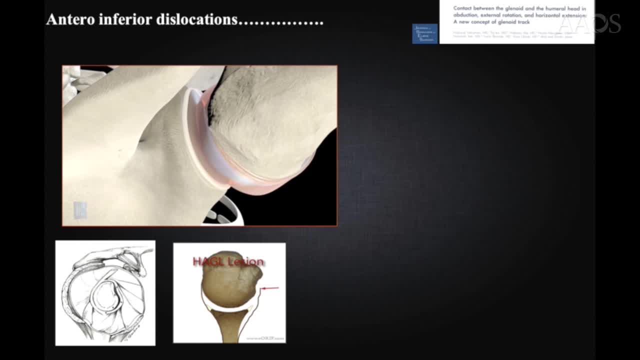 ON TRACK OFF TRACK SHOULDER INSTABILITY