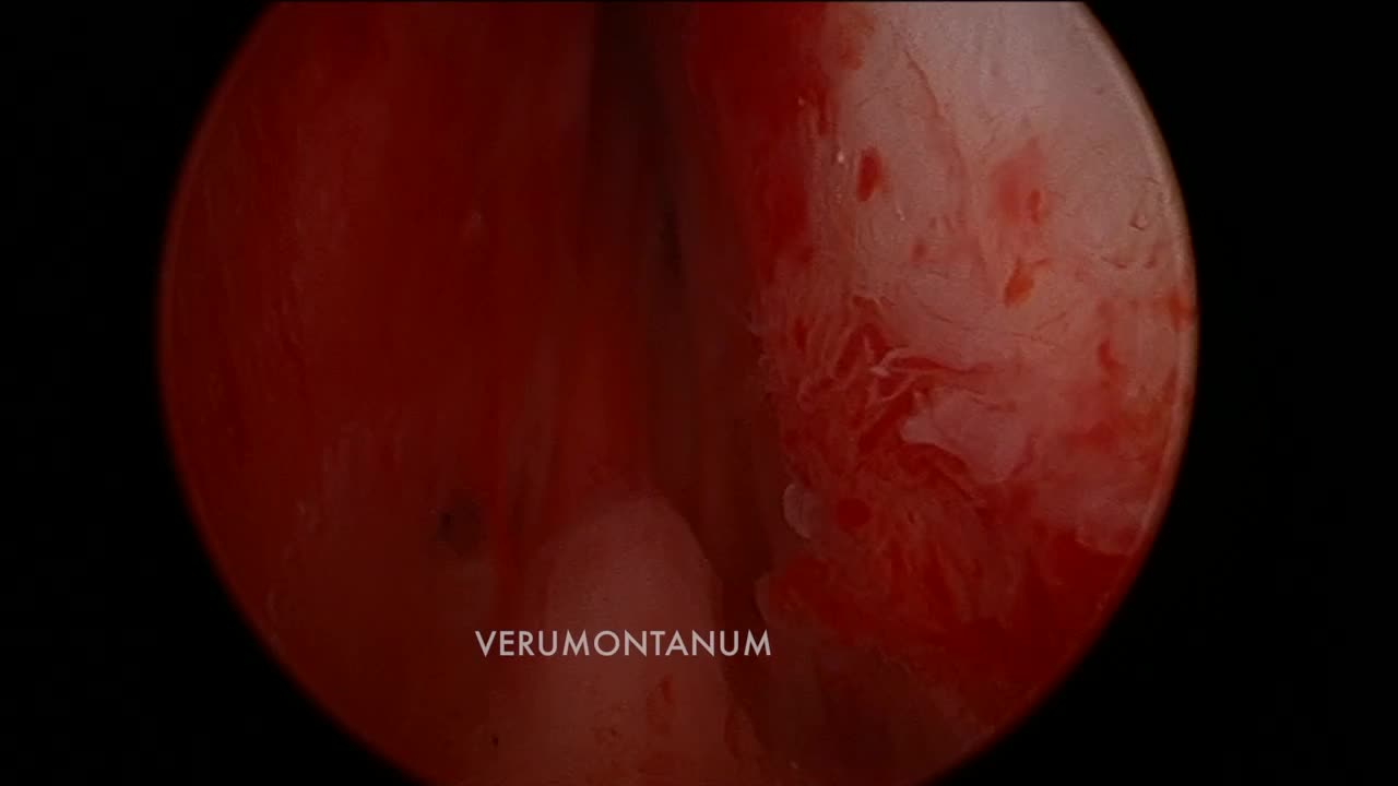 Green laser enucleation of the prostate (GreenLEP) en-blo..-