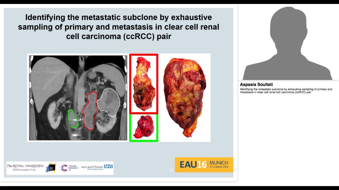 Identifying the metastatic subclone by exhaustive samplin-