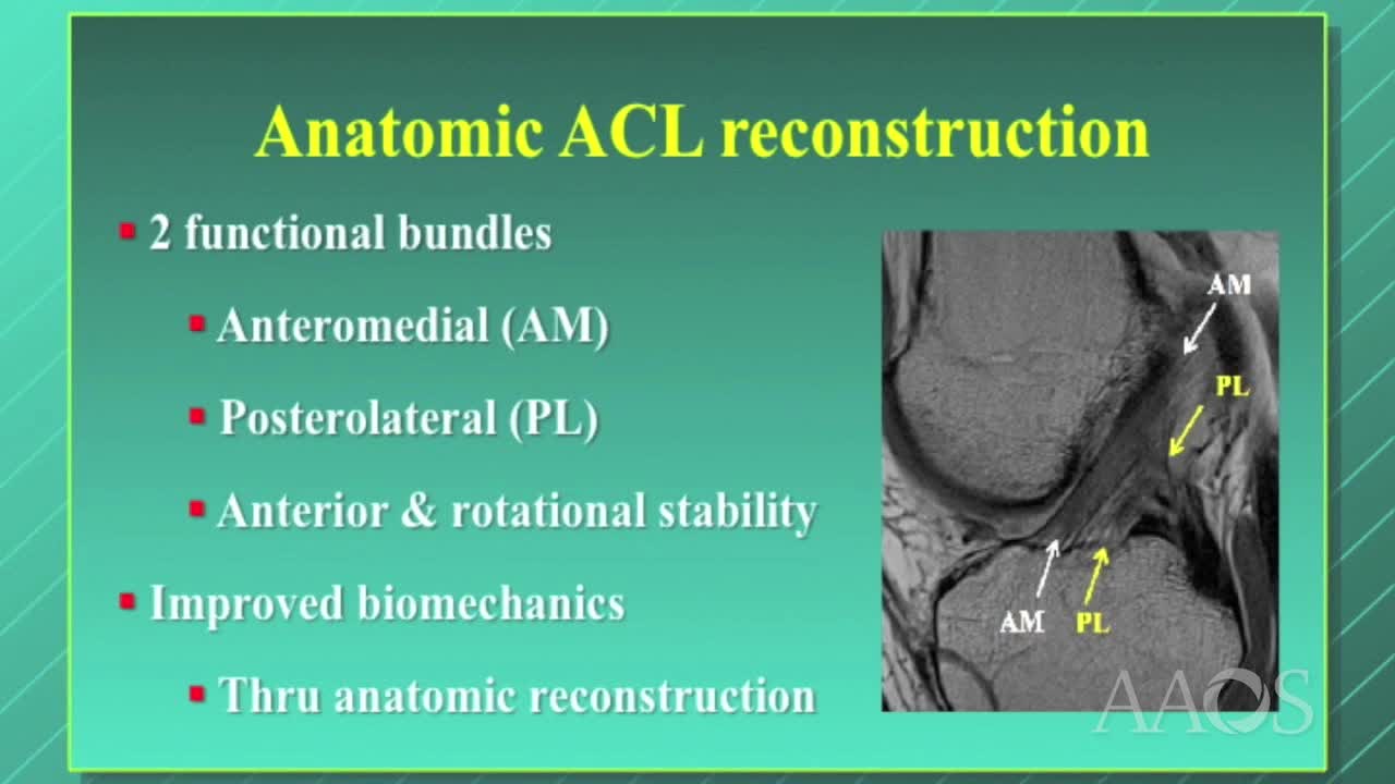 The Use of Remnant in Individualized Anatomic ACL Reconstruction
