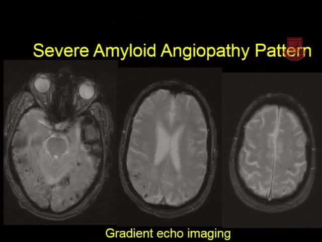 安全有效的老年人急性卒中治疗3