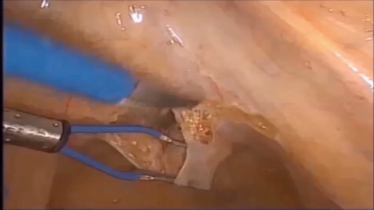 Nerve sparing laparoscopic radical prostatectomy with hyd..-