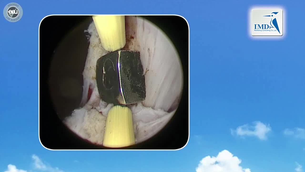 经尿道双极前列腺剜除术（3）