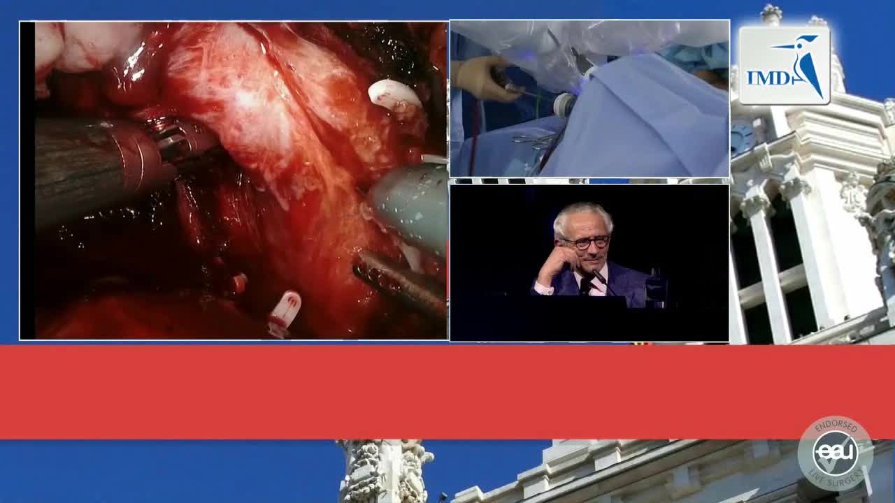 神经保留根治性前列腺切除术（4）