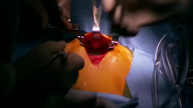 心脏手术修复先天性心脏缺陷