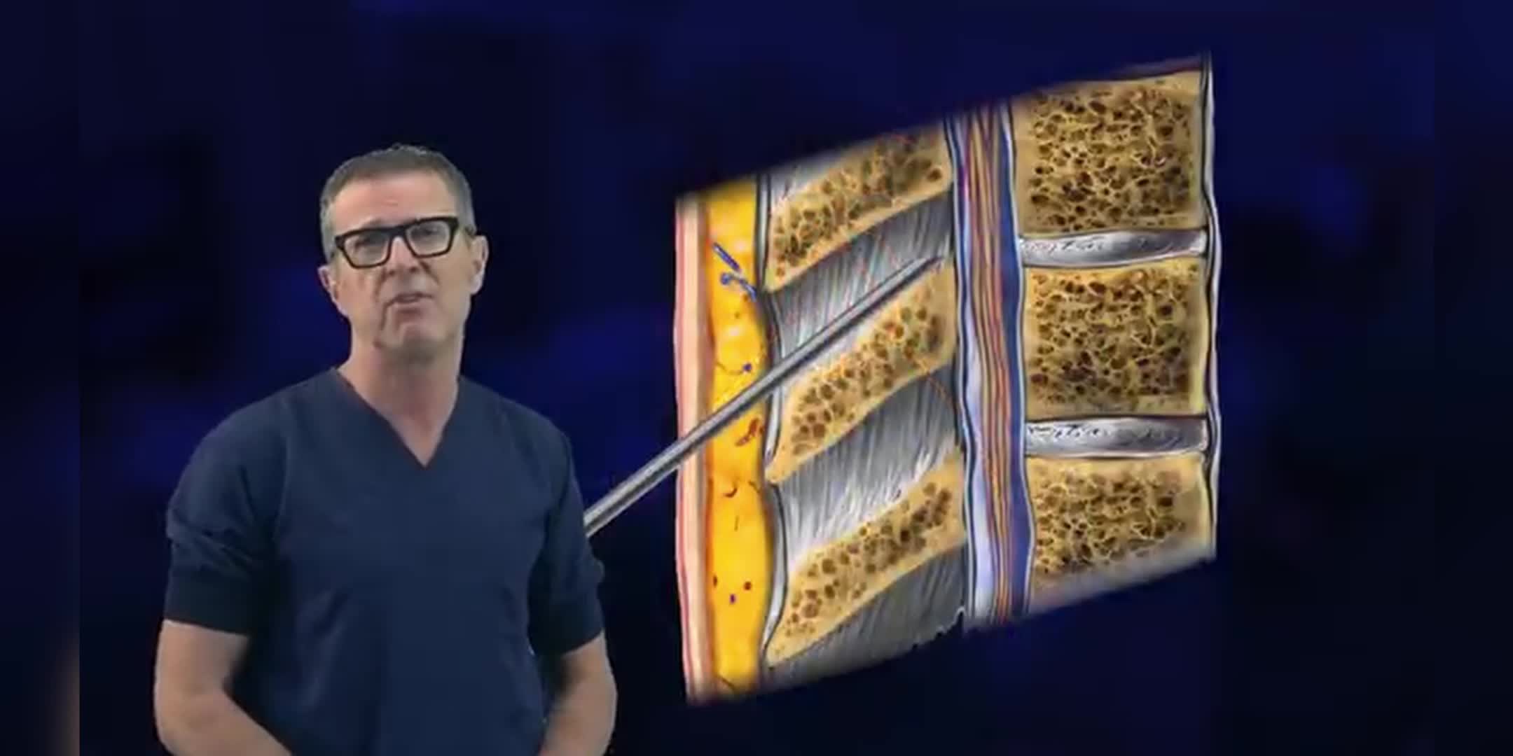 脊椎麻醉全面解析