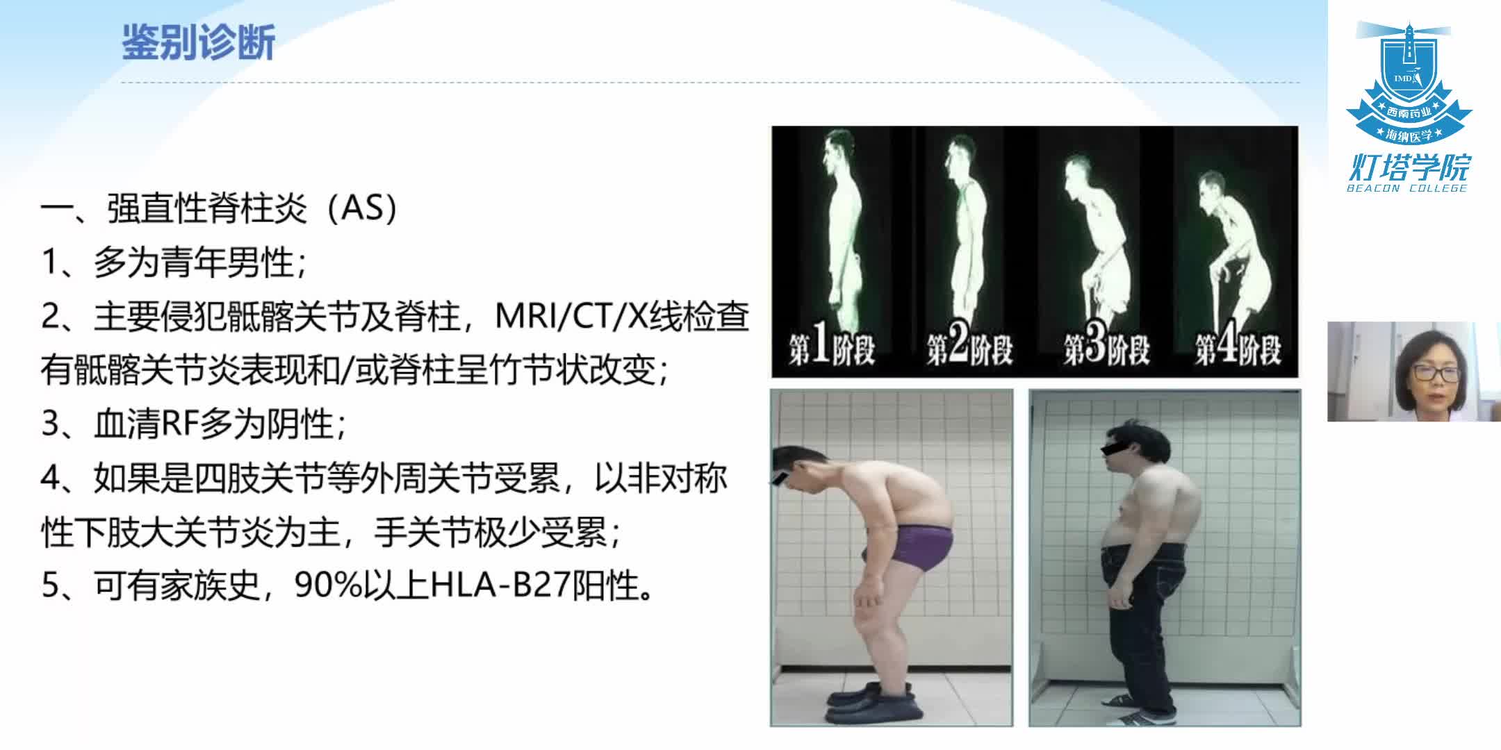 类风湿关节炎的治疗和鉴别诊断