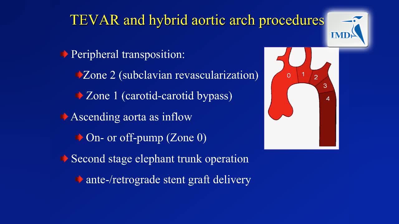 胸主动脉腔内修复术及主动脉弓分支手术（2）
