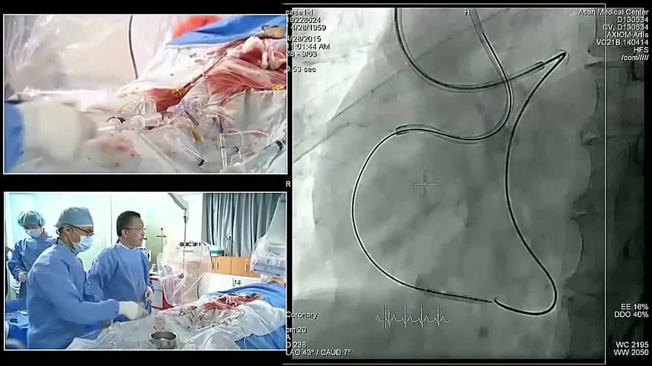 血管内手术现场案例一（3）