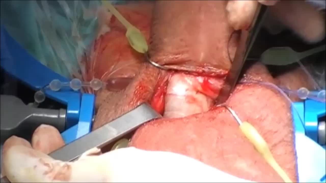 Surgical treatment of erectile dysfunction and Peyronie d..-