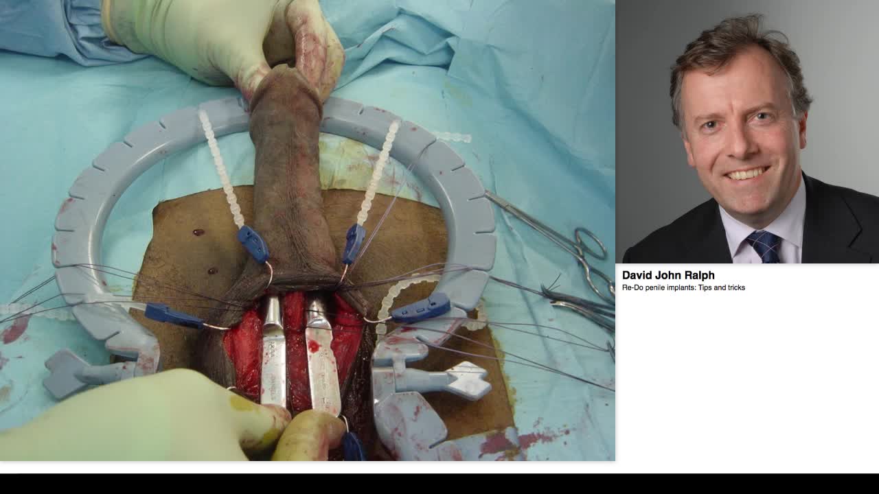 Re-Do penile implants, Tips and tricks