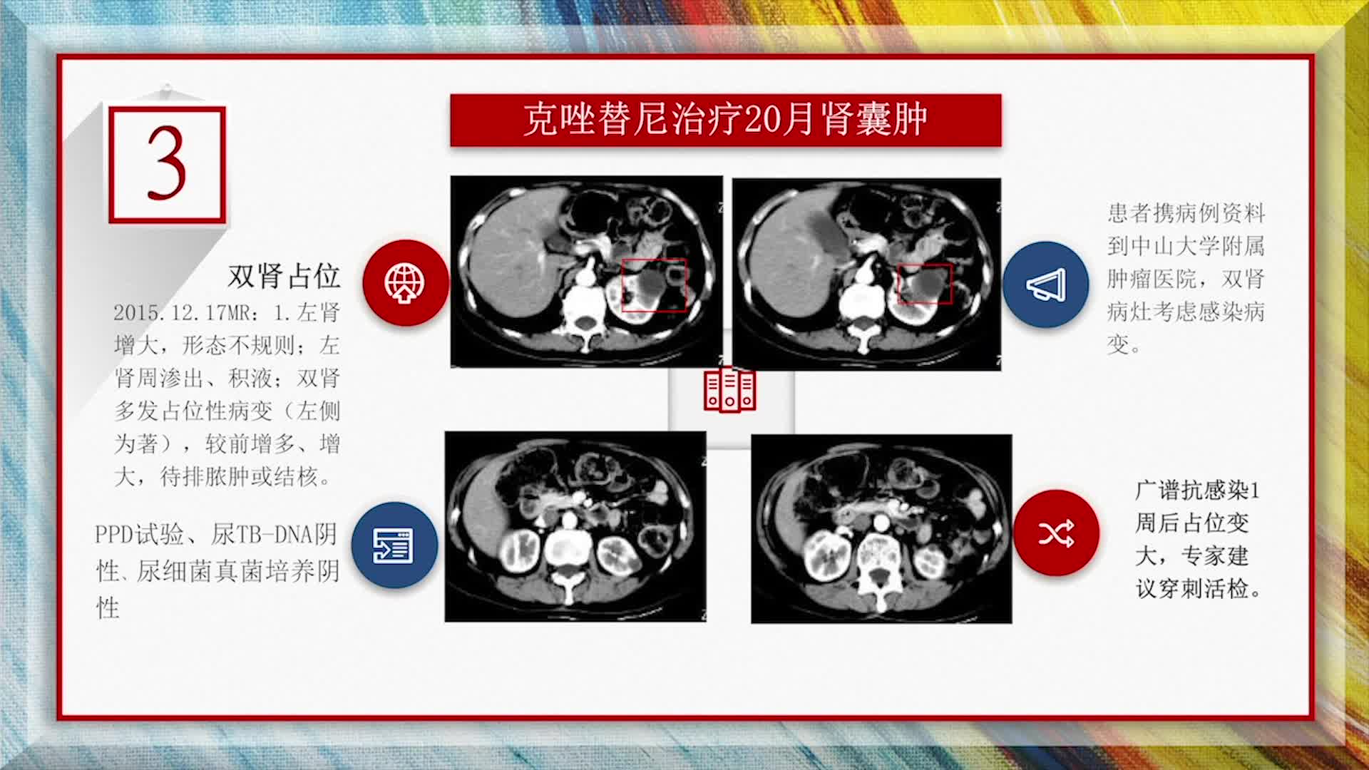 ALK阳性肺癌克唑替尼治疗并发肾囊肿的诊疗讨论