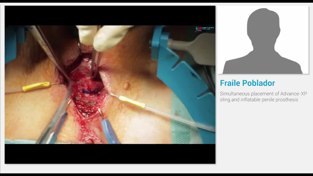 Simultaneous placement of Advance-XP sling and inflatable..-