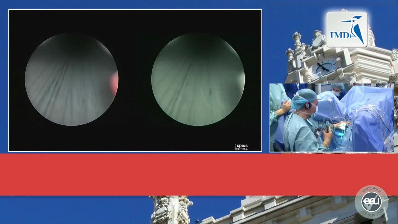 经尿道膀胱肿瘤切除手术（3）