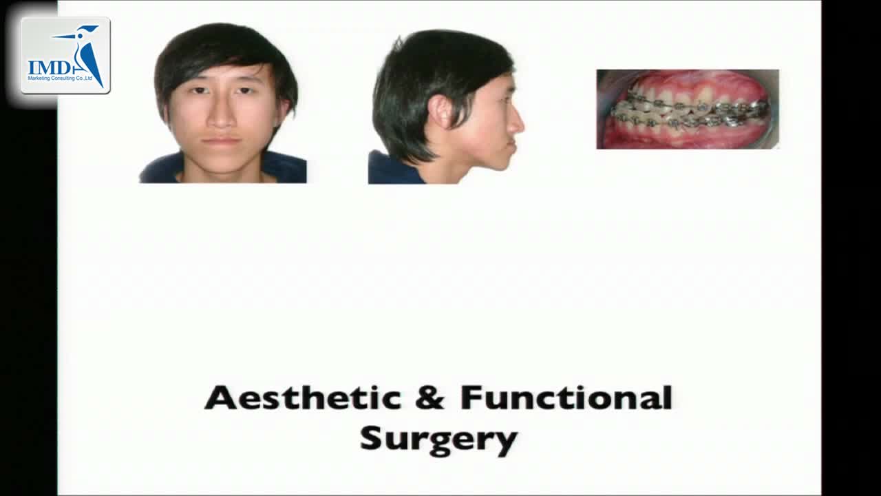 下巴微创整形手术（3）