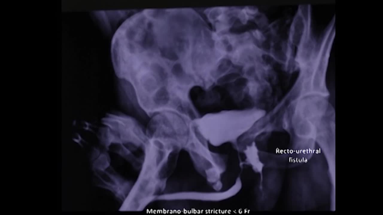A novel minimally invasive technique of transposing oment..-