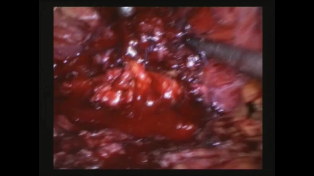 The usefulness of a new laparoscopic needle driver with r..-