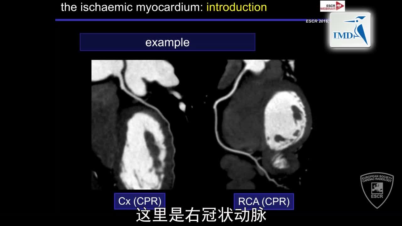 急性冠状动脉综合征发作后的影像诊断（2）