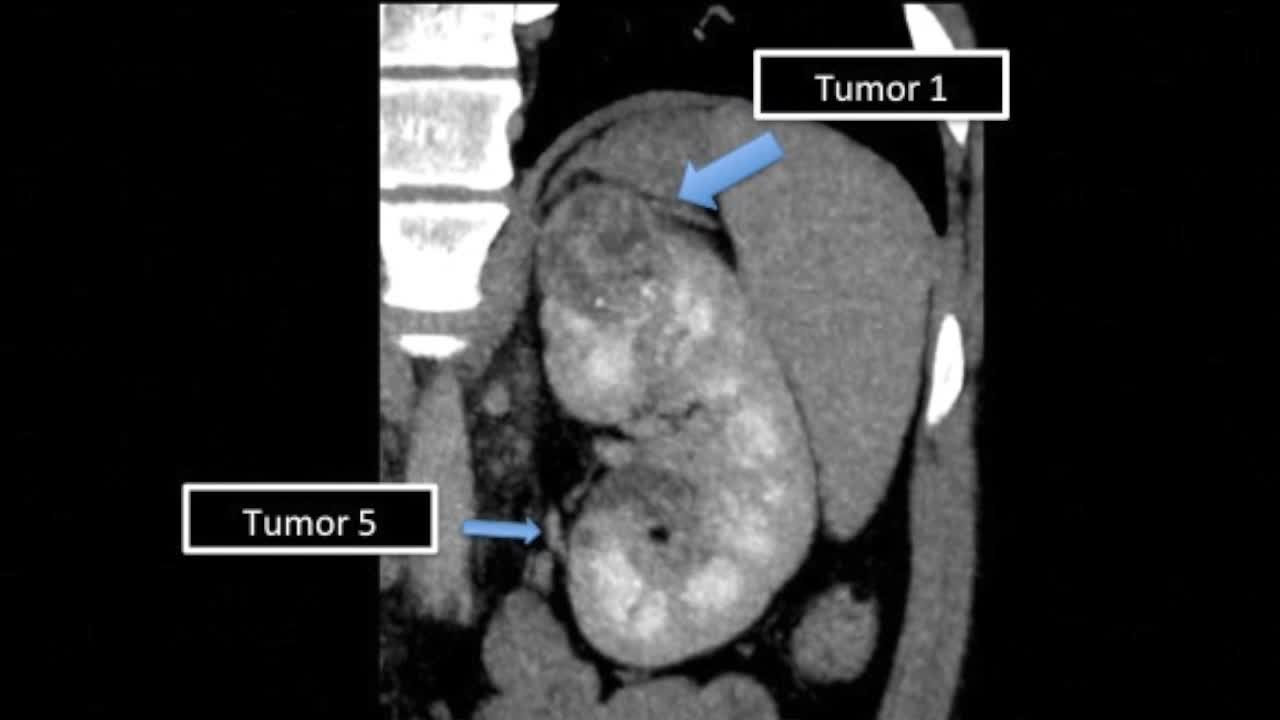 Benefit of the superselective clamping technique for mult..-