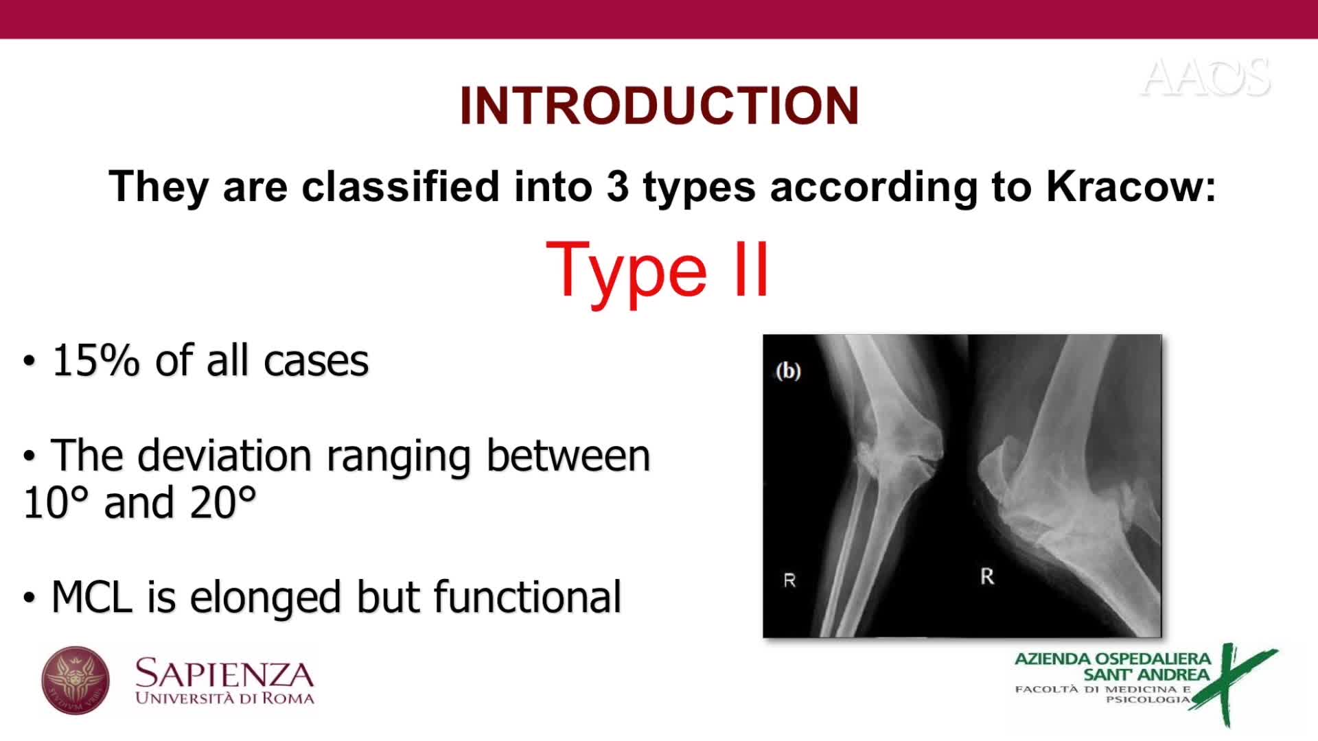 Lateral Epicondylar Sliding Osteotomy in Total Knee Arthroplasty for Rigid Valgus Deformity