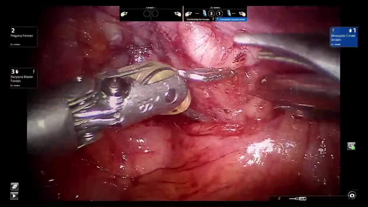 Trans Douglas robotic radical prostatectomy, Application ..-