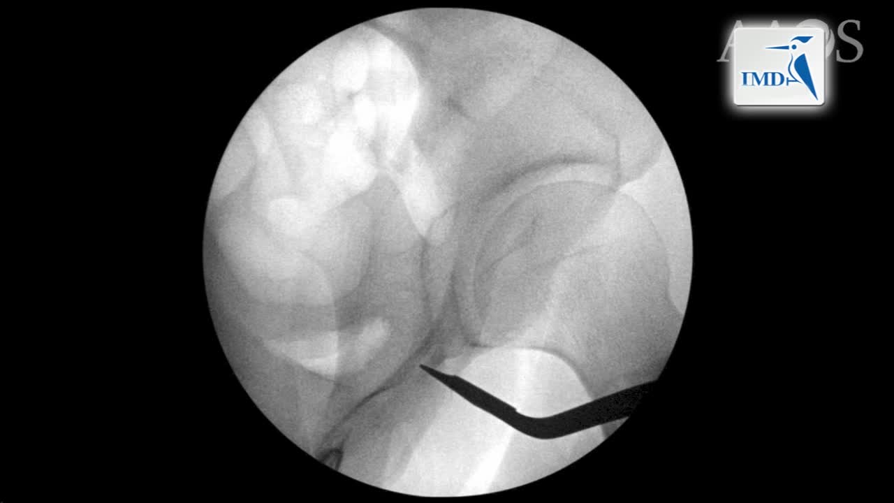 股直肌保留髋臼周围截骨手术（2）
