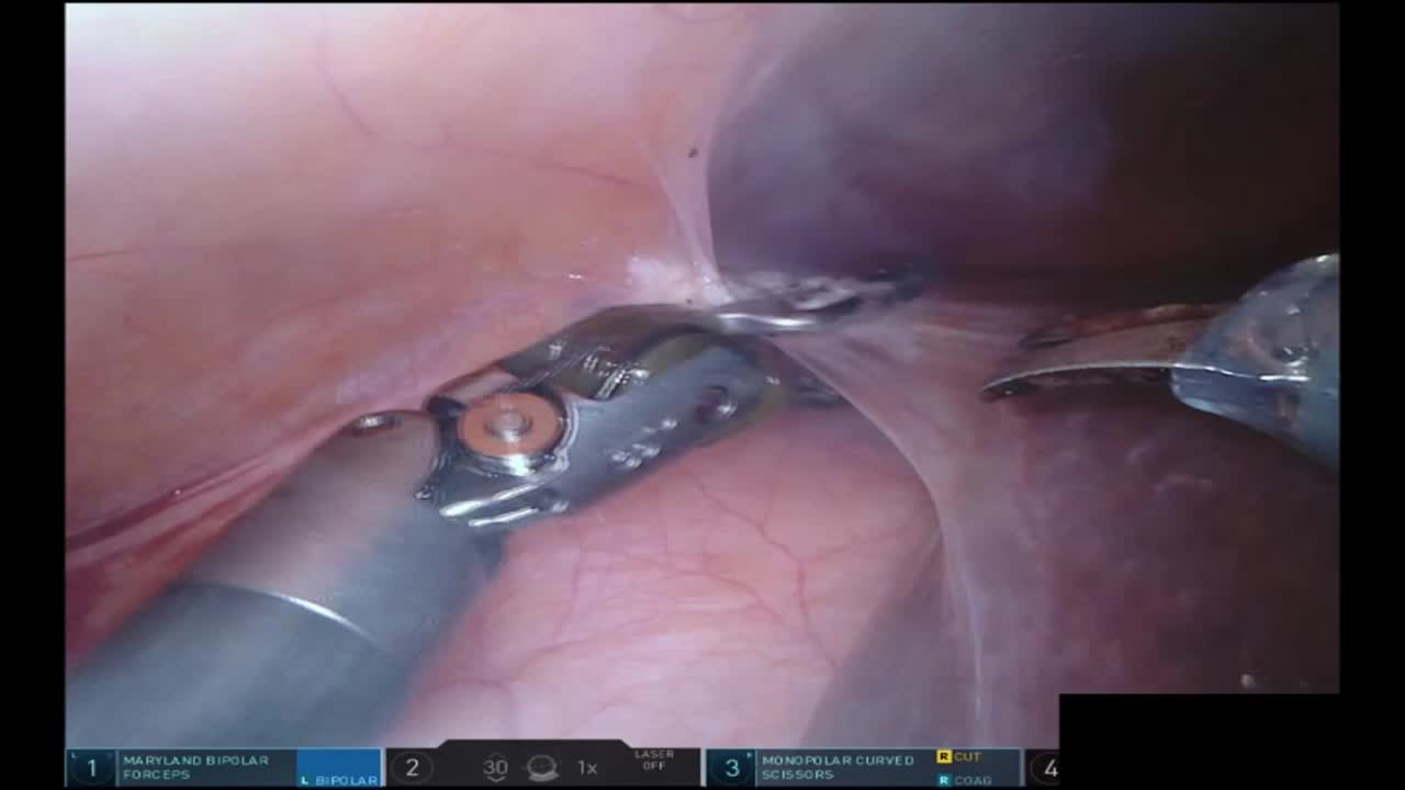 Robot-assisted adrenalectomy in case of bulky pheochromoc..-