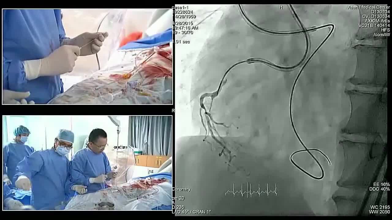 血管内手术现场案例一（2）