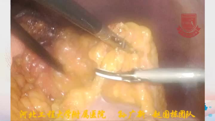赵国栋-3D腹腔镜远端胃根治术