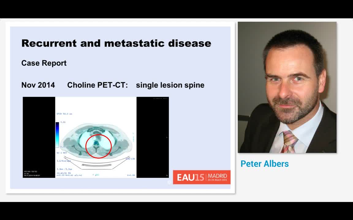 Recurrent and metastatic disease