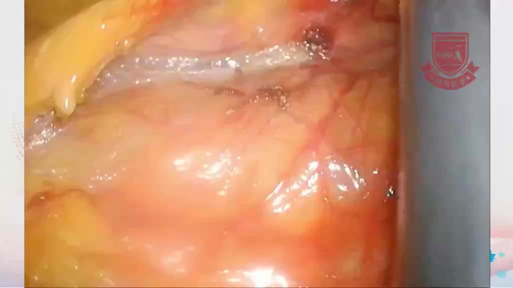 杨勇-全腹腔镜根治性右半结肠切除术