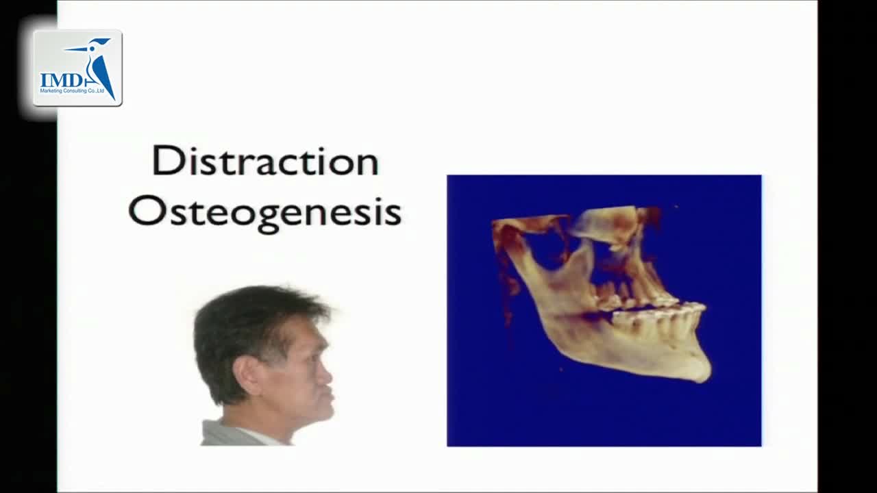 下巴微创整形手术（5）