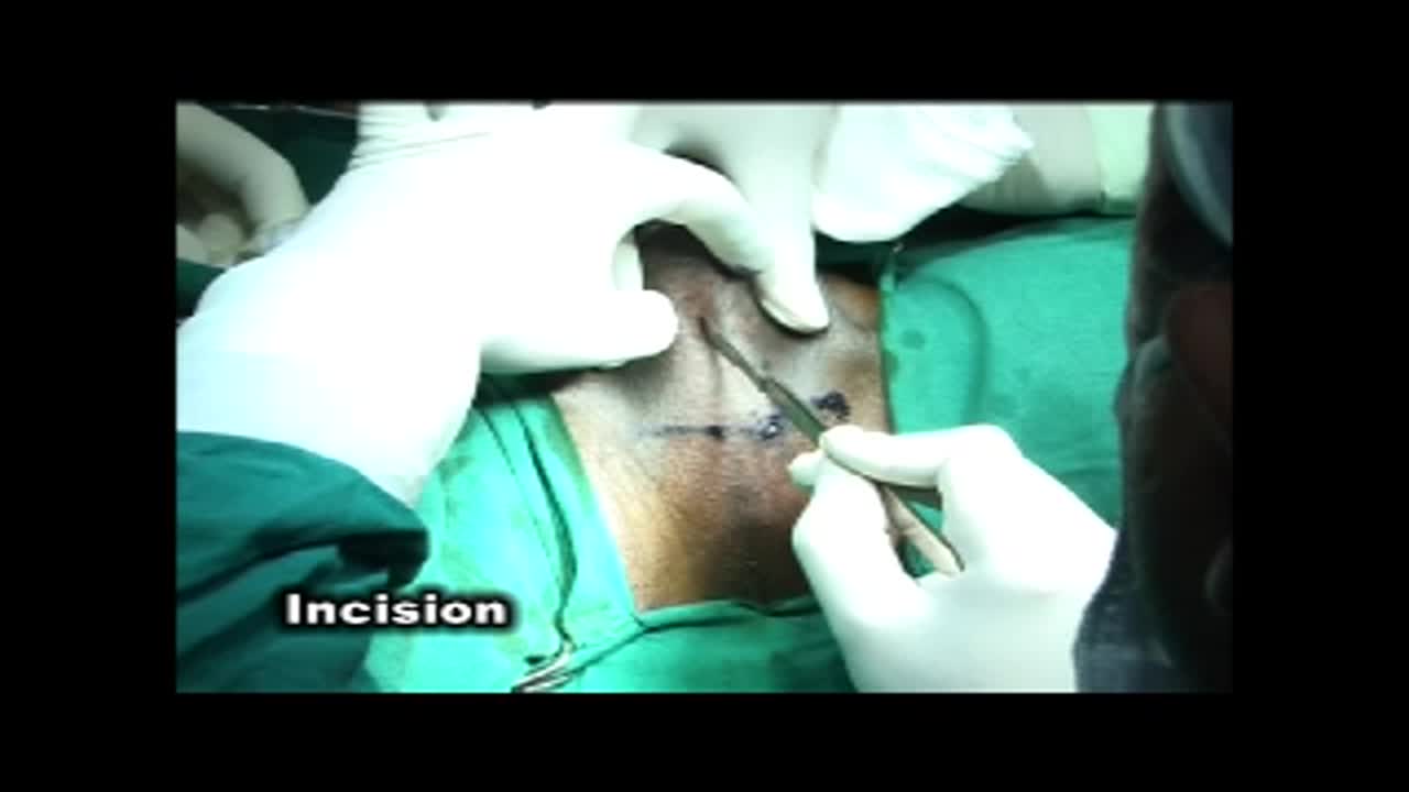 Technique of non transecting urethroplasty for short segm..-