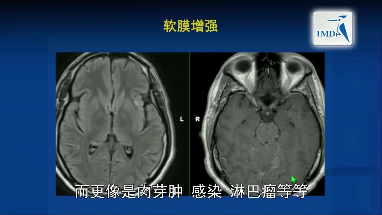 MRI与MS：一幅图是否值得冗言赘述？（7）