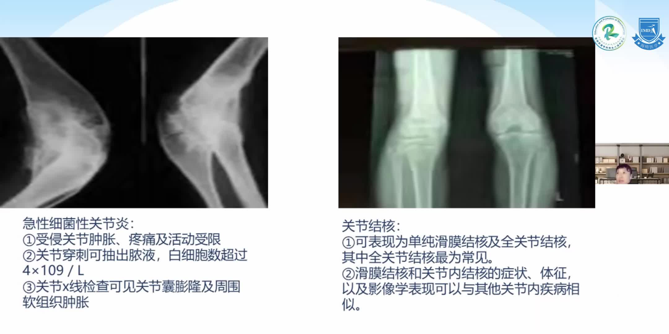 何芳-关节炎的诊断（3）