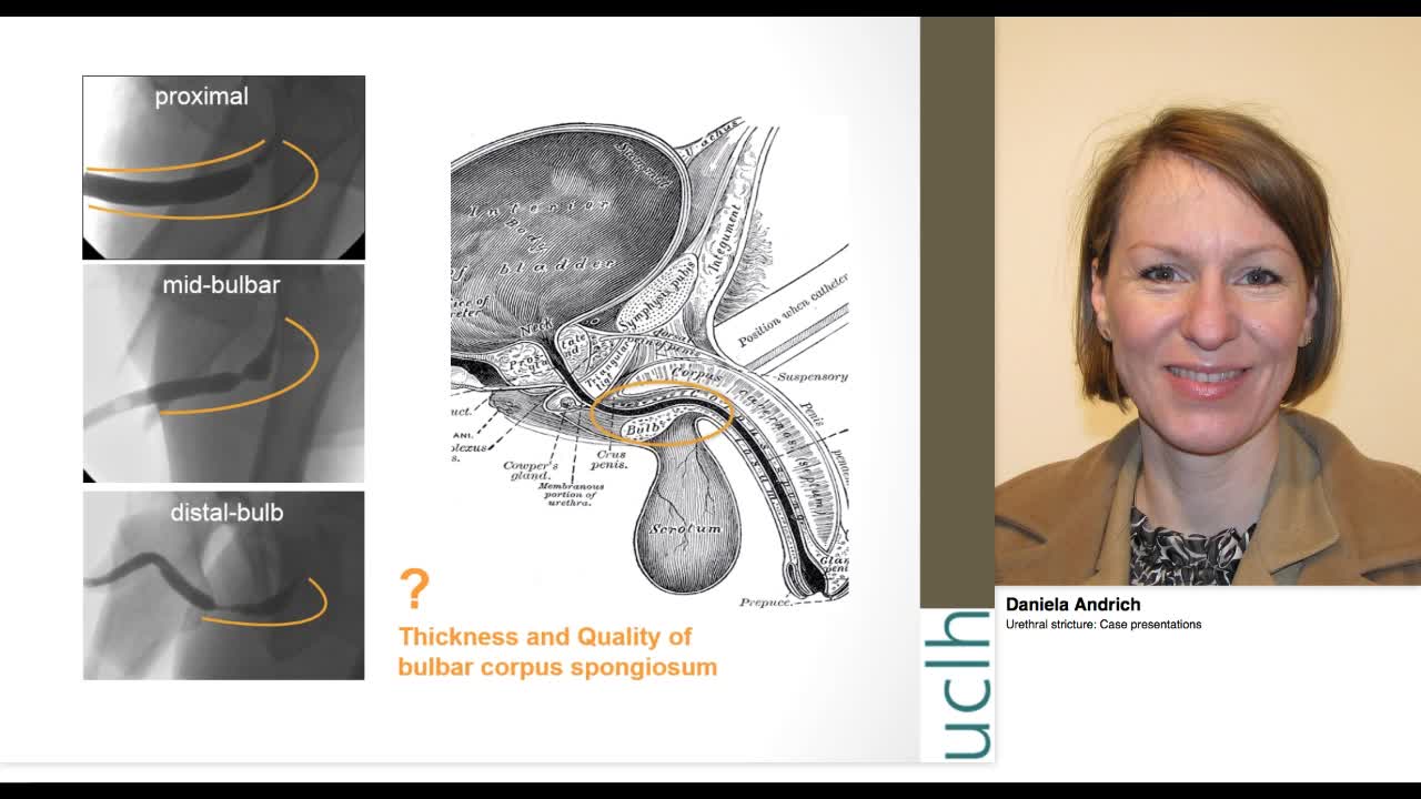 Urethral stricture, Case presentations