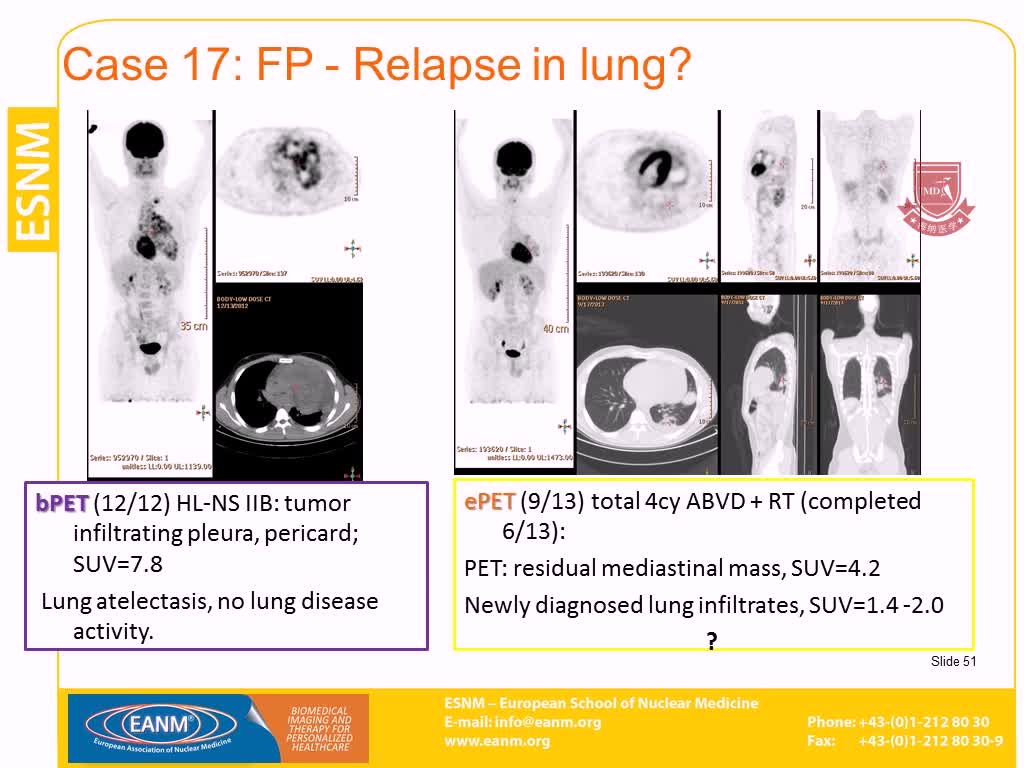 PET CT用于淋巴瘤6