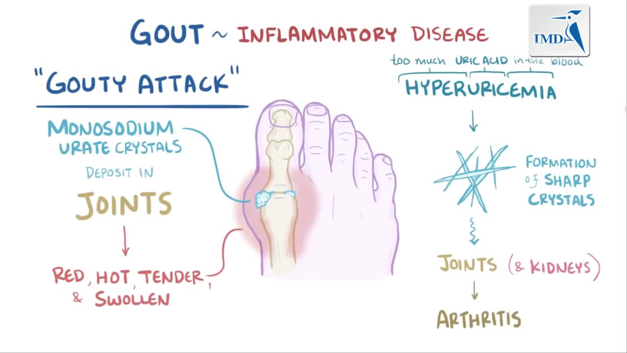 痛风：病因 症状 诊断 治疗及病理学