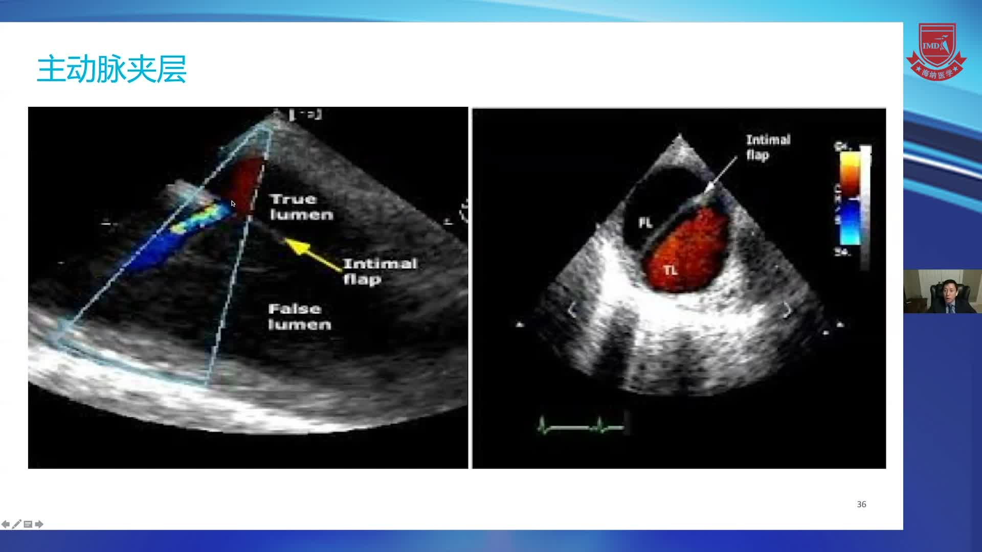 TEE常用切面之经食道心脏超声常用切面 黄佳鹏 _3