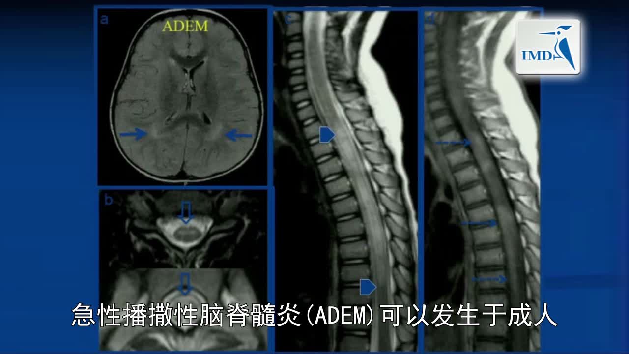 MRI与MS：一幅图是否值得冗言赘述（8）