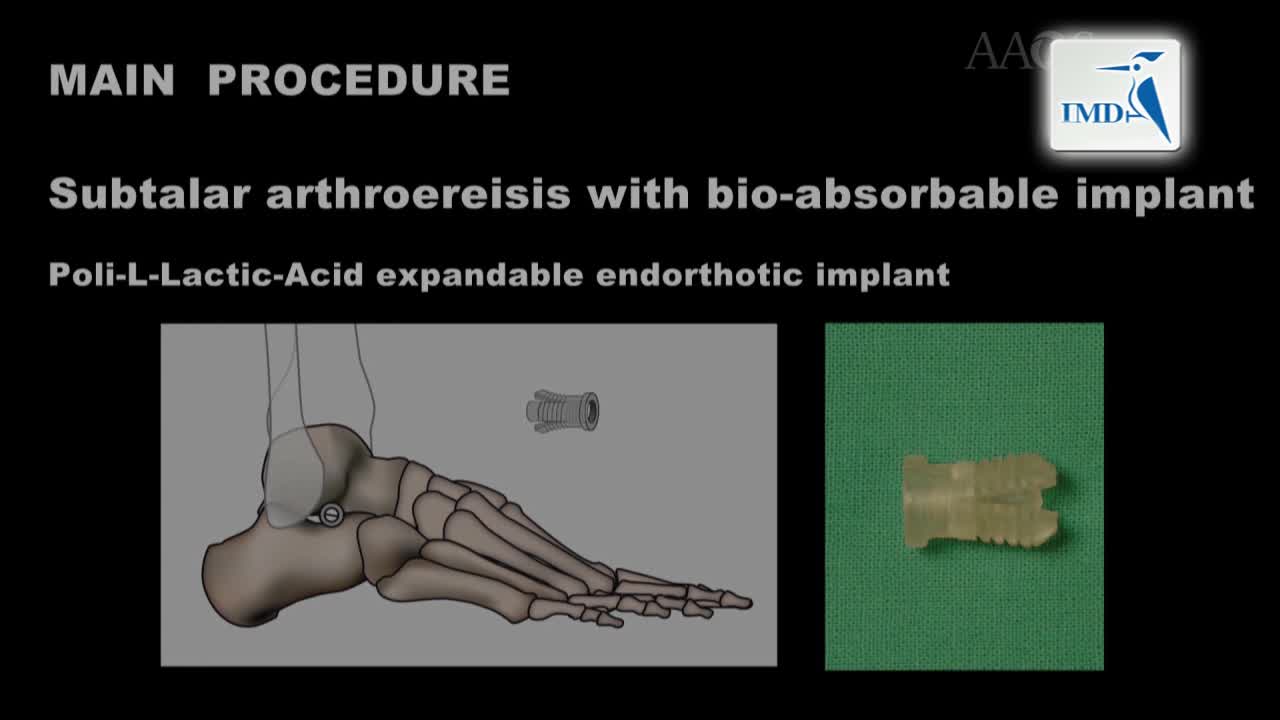 儿童易变性平足症的手术疗法：距骨下关节制动术及复合型手术（2）