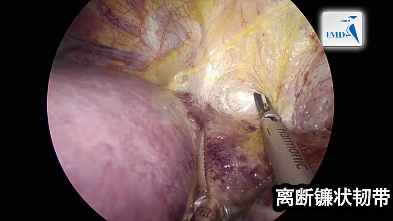 腹腔镜右半肝切除术和胆囊切除术