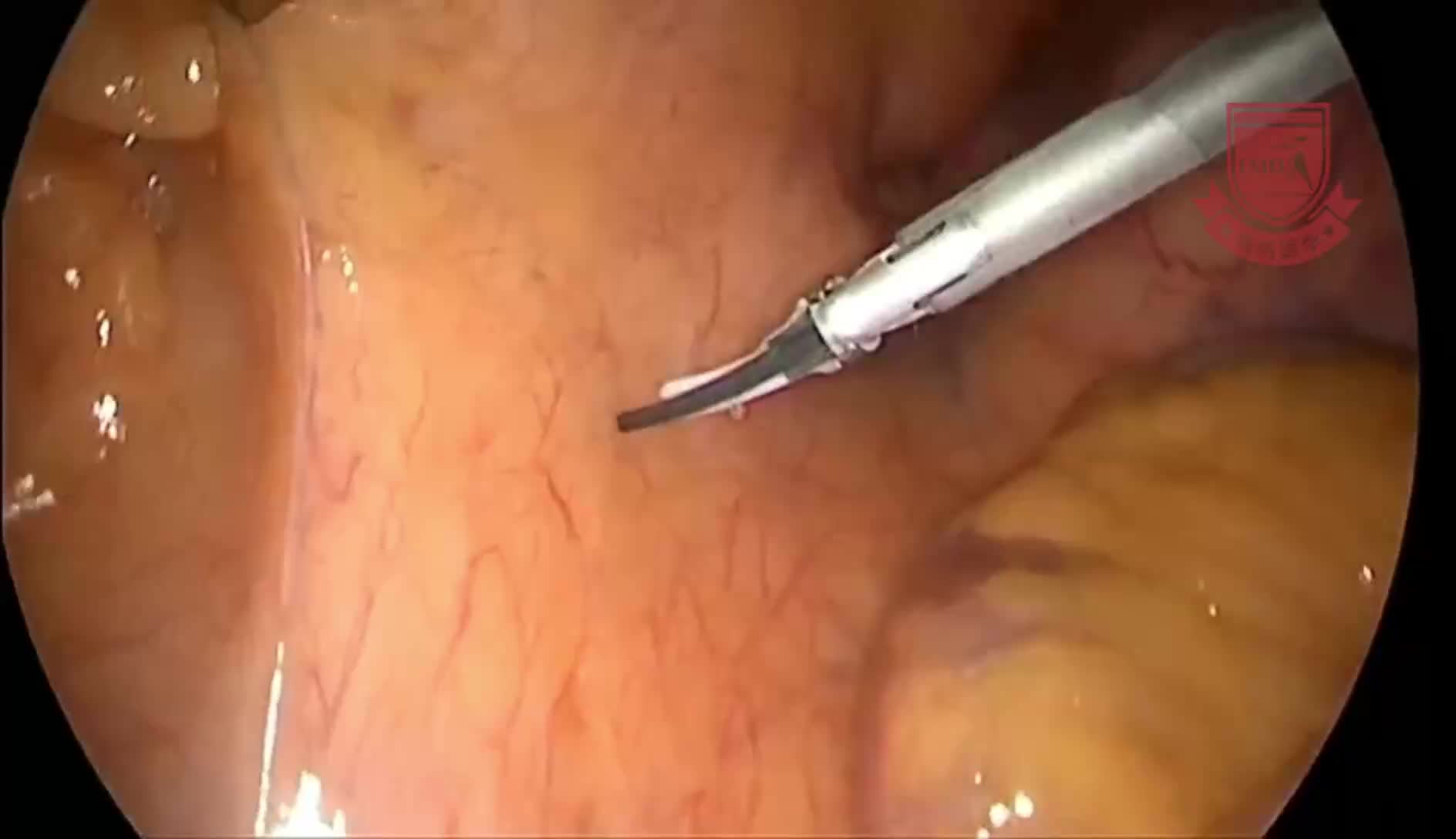 张涛-解剖肠系膜下动脉频