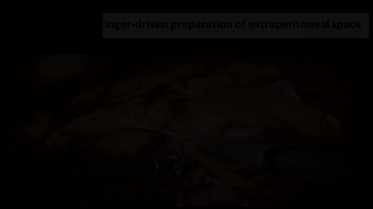 Full neurovascular preservation in radical prostatectomy