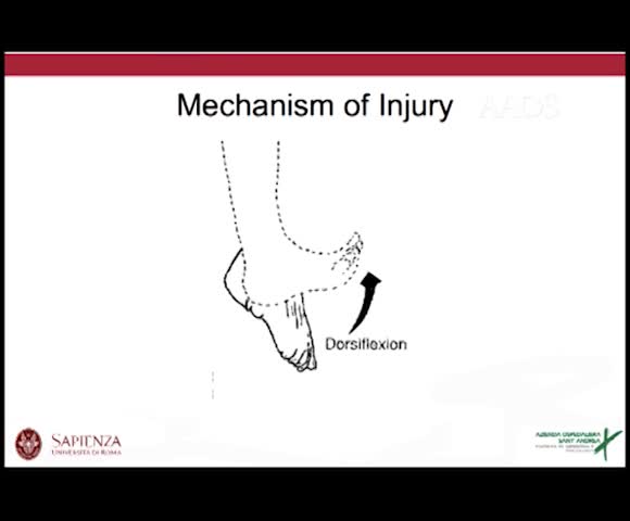 CHRONIC DISLOCATION OF PERONEAL TENDON  THE LANNELONGUE PROCEDURE